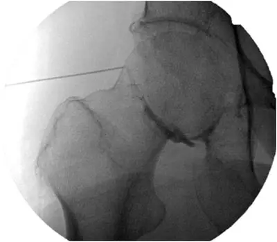 hip-injection
